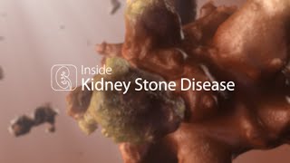 Medical Animation Kidney Stone Disease [upl. by Nywnorb]