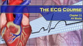 The ECG Course  AV Blocks [upl. by Nuhsed]