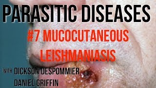 Parasitic Diseases Lectures 7 Mucocutaneous Leishmaniasis [upl. by Ceciley622]