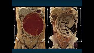 Mucinous Cystic Neoplasm of the Pancreas CT Appearance with Key Imaging Features  Part 2 [upl. by Eneres]