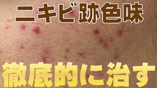 【美容】ニキビ跡で黒・茶色・色素沈着してしまった肌を徹底的に治す方法教えます。 [upl. by Sonahpets]