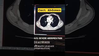 Cect Abdomen scan Perforation ctscan abdomen anatomy abdomenpain perforation leakage cect [upl. by Nolahp]