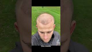 HAIR TRANSPLANT BEFORE AFTER  11 MONTHS [upl. by Rettke964]