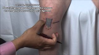 Knee Injection  Anterior Approach [upl. by Cantlon]