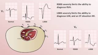 Intro to EKG Interpretation  Bundle Branch Blocks [upl. by Southworth521]