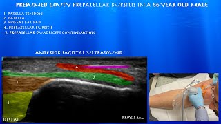 Ultrasound Guided Cortisone Injection for Presumed Gouty Prepatellar Bursitis in a 66 Year Old Male [upl. by Ferguson554]