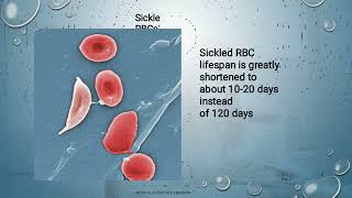 Sickle Cell Disease Lecture [upl. by Ydnarb]