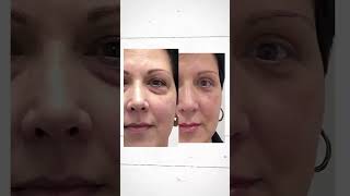 Blepharoplasty Before amp After [upl. by Aara422]