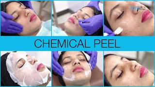 Chemical Peel  Chemical Peel for Acne  Chemical peel Before After Zolie Skin clinic [upl. by Salohcim]