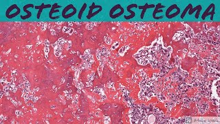 Osteoid Osteoma Bone Pathology Basics [upl. by Enahpets672]