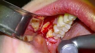 Horizontal Impacted Wisdom Tooth  Sonic Surgery  Dr Fabio Cozzolino  Zerodonto [upl. by Neenad]