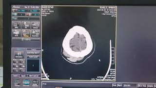 Scalp Heamatoma on CT Brain [upl. by Legnaleugim772]