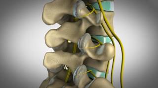 Orlando Chiropractic  Custom 3D animation visualizing facet syndrome and how chiropractic can help [upl. by Ahsial]