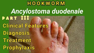 Hookworm  Ancylostomiasis Clinical Features Diagnosis Treatment Prophylaxis  AM Biologie Notes [upl. by Yanetruoc]