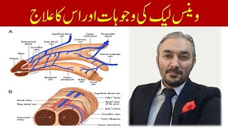 venous leak causes and treatment  venous leak ka ilaj in UrduHindi  Dr Fartash Sarwar [upl. by Nehemiah827]