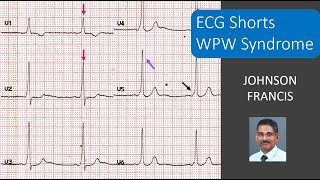 ECG Shorts  WPW Syndrome [upl. by Noslien]