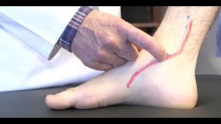 How to diagnose Posterior Tibial Tendonitis [upl. by Neffirg843]