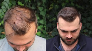 Hair Transplant Result with 3040 Grafts  EXTREME TRANSFORMATION from 0 days to 10 Months [upl. by Adnahc]