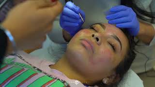 TCA Cross for Acne Scarring  Live with Dr Emer [upl. by Charron211]