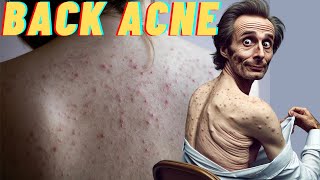 Dealing with Back Acne Causes Treatment and Prevention Explained Simply [upl. by Yelrebmik]