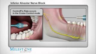 Inferior Alveolar Nerve Block [upl. by Drhacir]