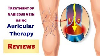 Natural Treatment of Varicose Veins  Reviews on Jagmohan Sachdevas Auricular Therapy [upl. by Elmore]