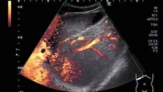 Ultrasound Video showing Hepatic parenchymal disease in a young patient of about 23 years [upl. by Pergrim]