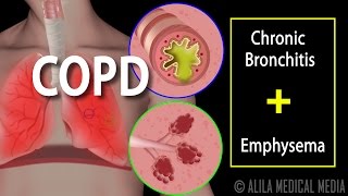 COPD  Chronic Obstructive Pulmonary Disease Animation [upl. by Alisha]