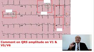 EKG Trainer Case 5 Questions [upl. by Chemarin332]