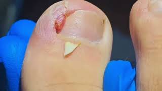 Deep Ingrown Nail Infection RELIEF After Instant Removal [upl. by Cassius]