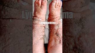 🦶Lymphoedema amp Chronic Venous Insufficiency 🦶lymphoedema venousinsufficiency podiatry [upl. by Anele645]