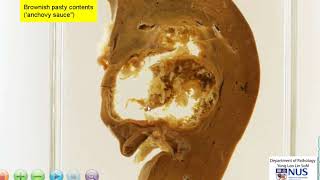 Liver Amoebic abscess gross pathology [upl. by Antonin340]