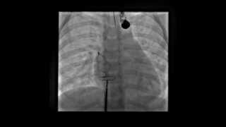 ASD Occluder release from Right Upper Pulmonary Vein [upl. by Reames]