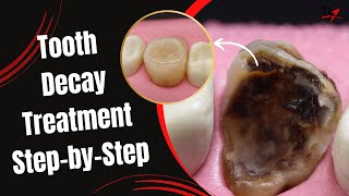 Restoration of a Massive Tooth Decay [upl. by Atirehs]