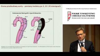 prof Zbigniew Gaciong  Ostre rozwarstwienie aorty  leczenie zachowawcze jest wystarczające [upl. by Einaj]