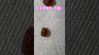 fungus spores mold skin flukes morgellons myjourney skin condition ulcer help share win [upl. by Annecorinne]