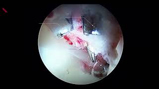 Surgical Technique  Puncture Capsulotomy Technique During Hip Arthroscopy [upl. by Enivid877]