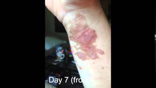 Grease Burn treated with Tamanu Oil 10 Days [upl. by Rexanna]