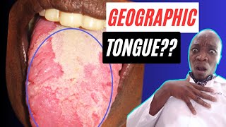 What is a Geographic Tongue  Benign Migratory Glossitis Treatment for a Geographic Tongue [upl. by Evilo]