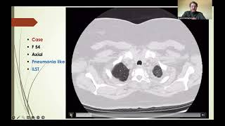 Reticular opacities part 3 English version [upl. by Naawaj]