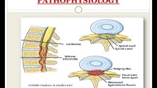 Spinal Stenosis  Medical PowerPoint Presentation [upl. by Garek504]