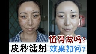 PicoSure Laser Review  BeforeampAfter皮秒镭射体验＋前后对比MsLindaY [upl. by Bondon]