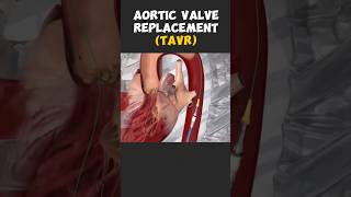 Aortic Valve Replacement [upl. by Pollock984]