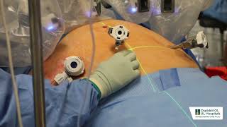 Robotic assiisted hysterectomy [upl. by Nollaf]