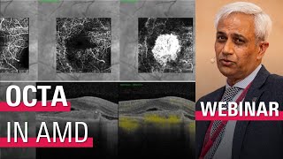 Identifying CNV with OCT Angiography Imaging [upl. by Estrellita]