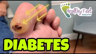 Diabetic Blister How to Treat Diabetic Ulcers [upl. by Ehcropal]