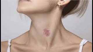 how to properly remove a hickey in minutes  hickey removal tricks [upl. by Nivets]