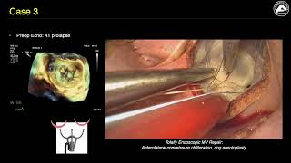 Commissural MR in the Minimally Invasive Cardiac Surgery Era A Piece of Cake [upl. by Franckot]