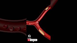 Ischemic Stroke by a Blood Clot Cerebral Vascular Accident [upl. by Yhtomit]