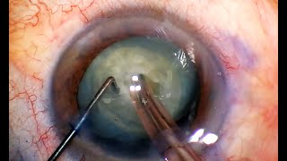 Phaco Chop Mastery Horizontal and Vertical for Safe Cataract Surgery [upl. by Dorella61]